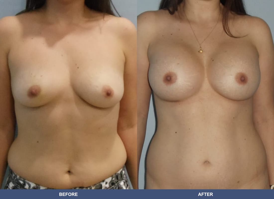 Painless Breast Implants before and after