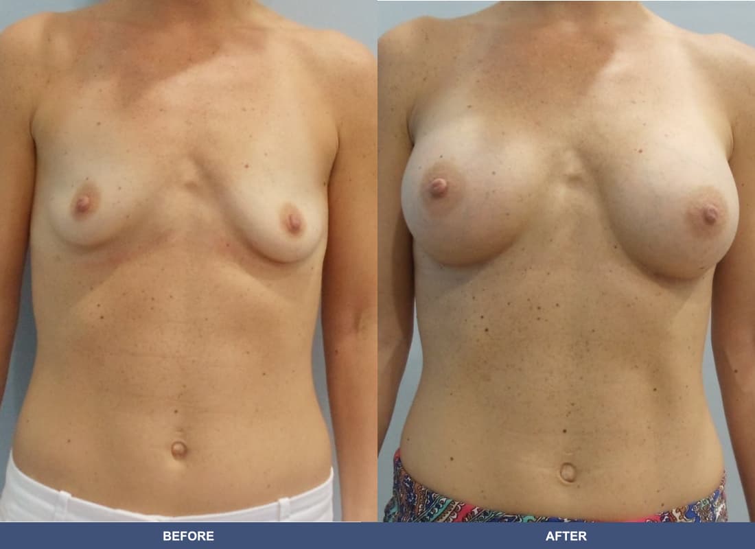 Painless Breast Implants before and after