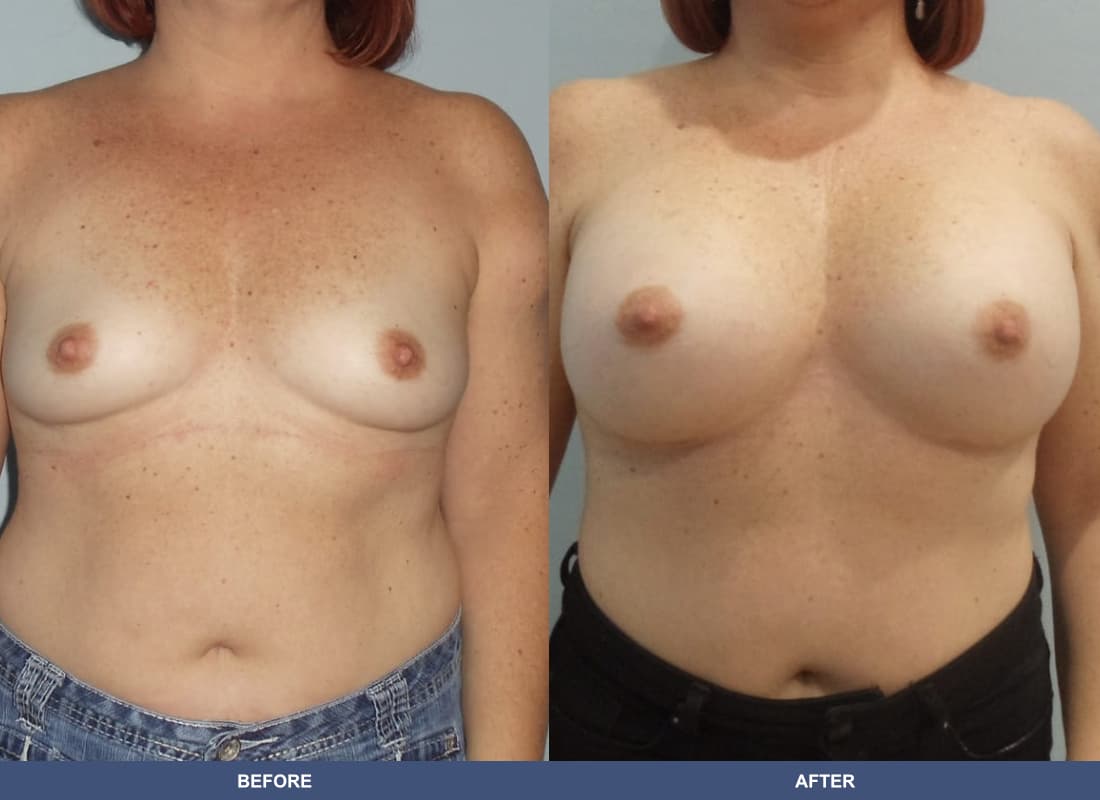 Painless Breast Implants before and after