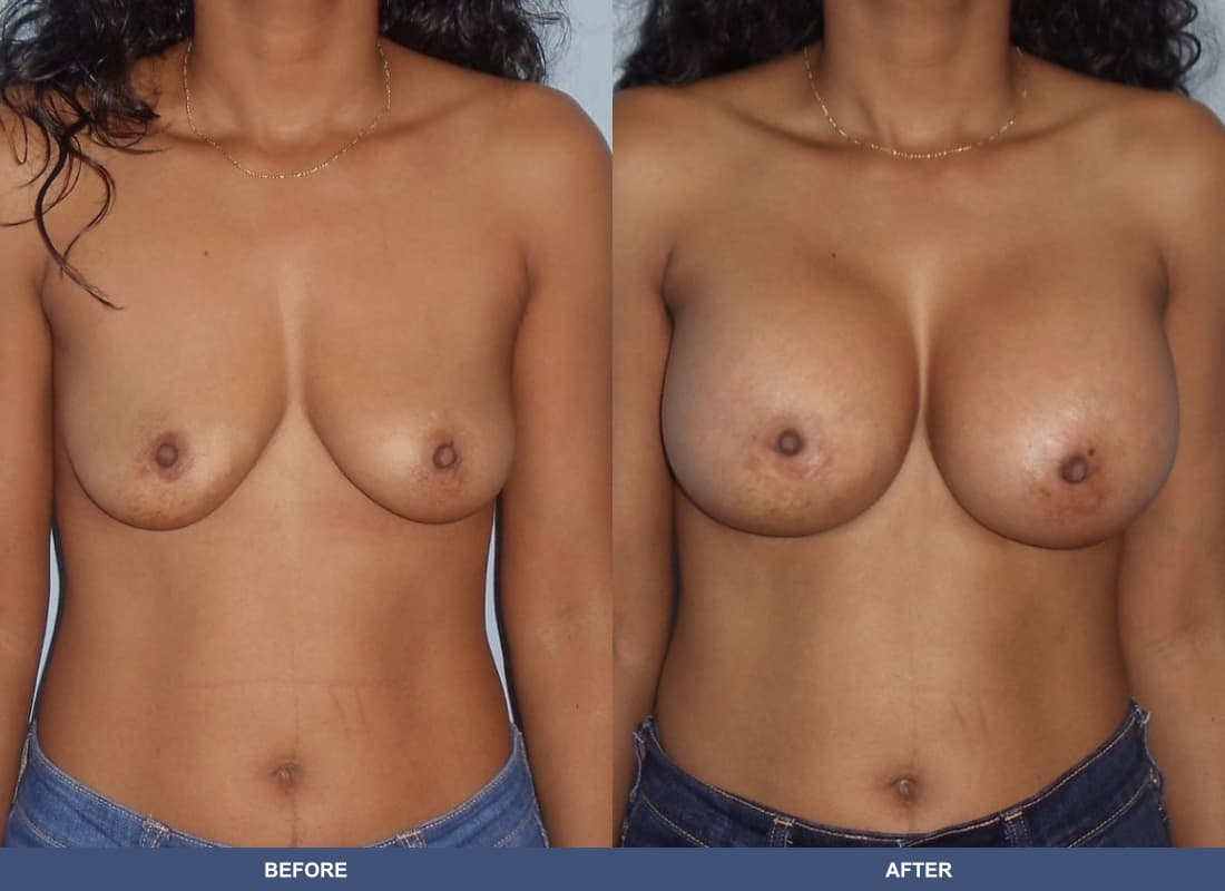 Painless Breast Implants before and after