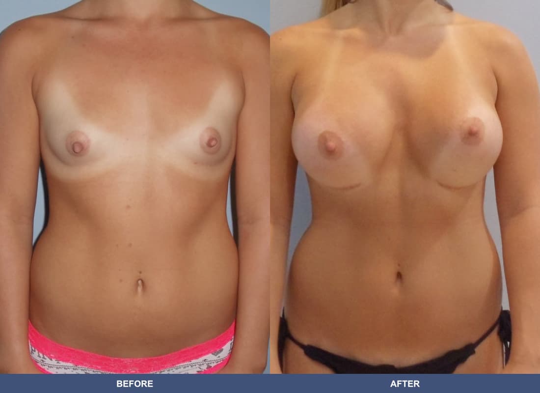 Painless Breast Implants before and after
