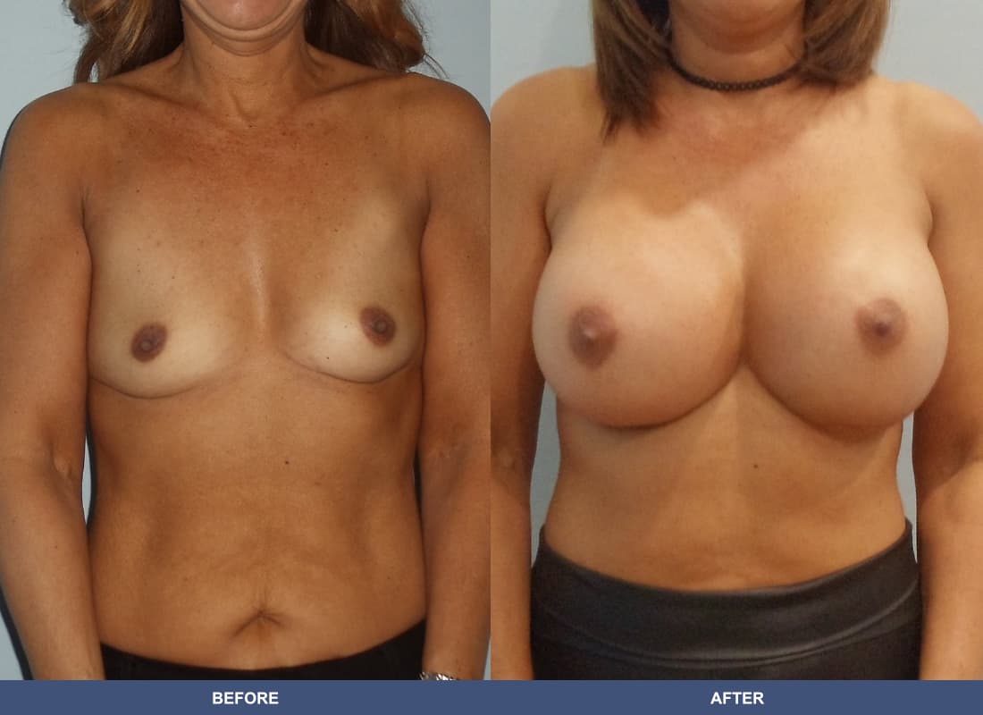 Painless Breast Implants before and after