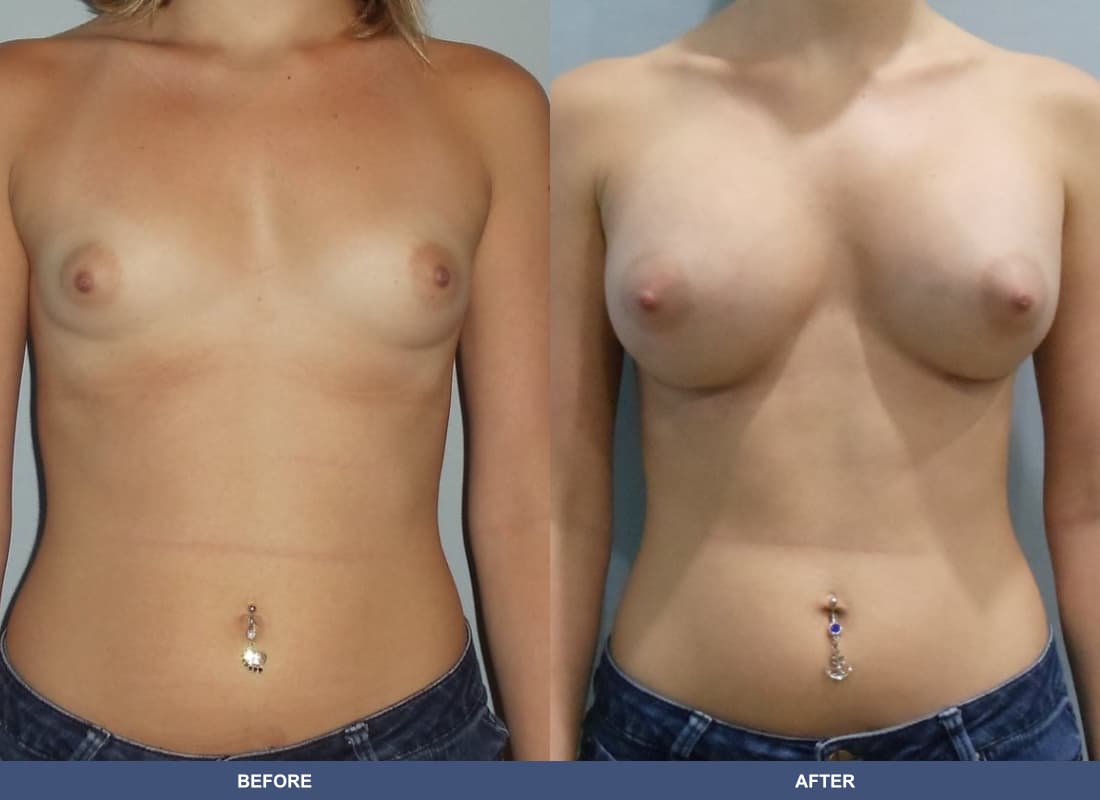 Painless Breast Implants before and after