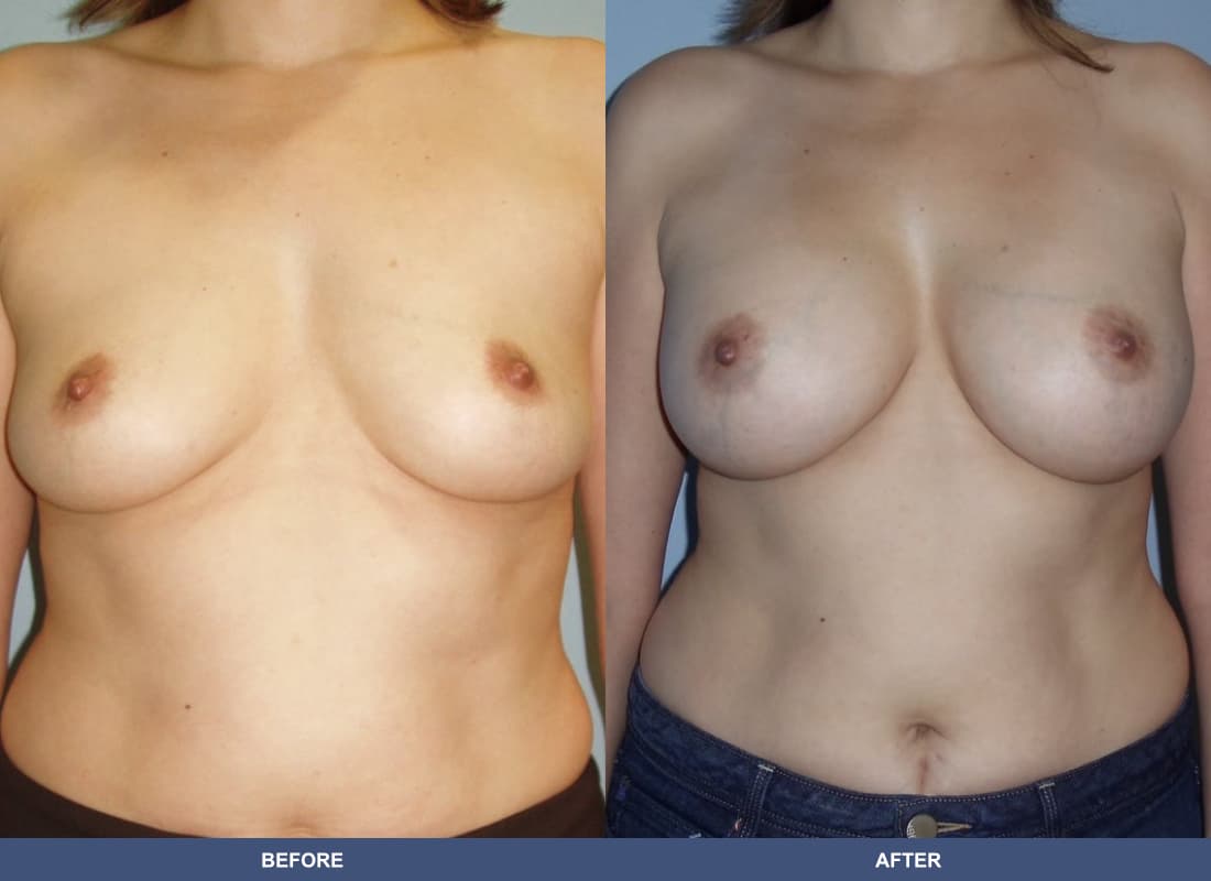 Painless Breast Implants before and after