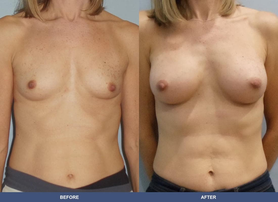 Painless Breast Implants before and after