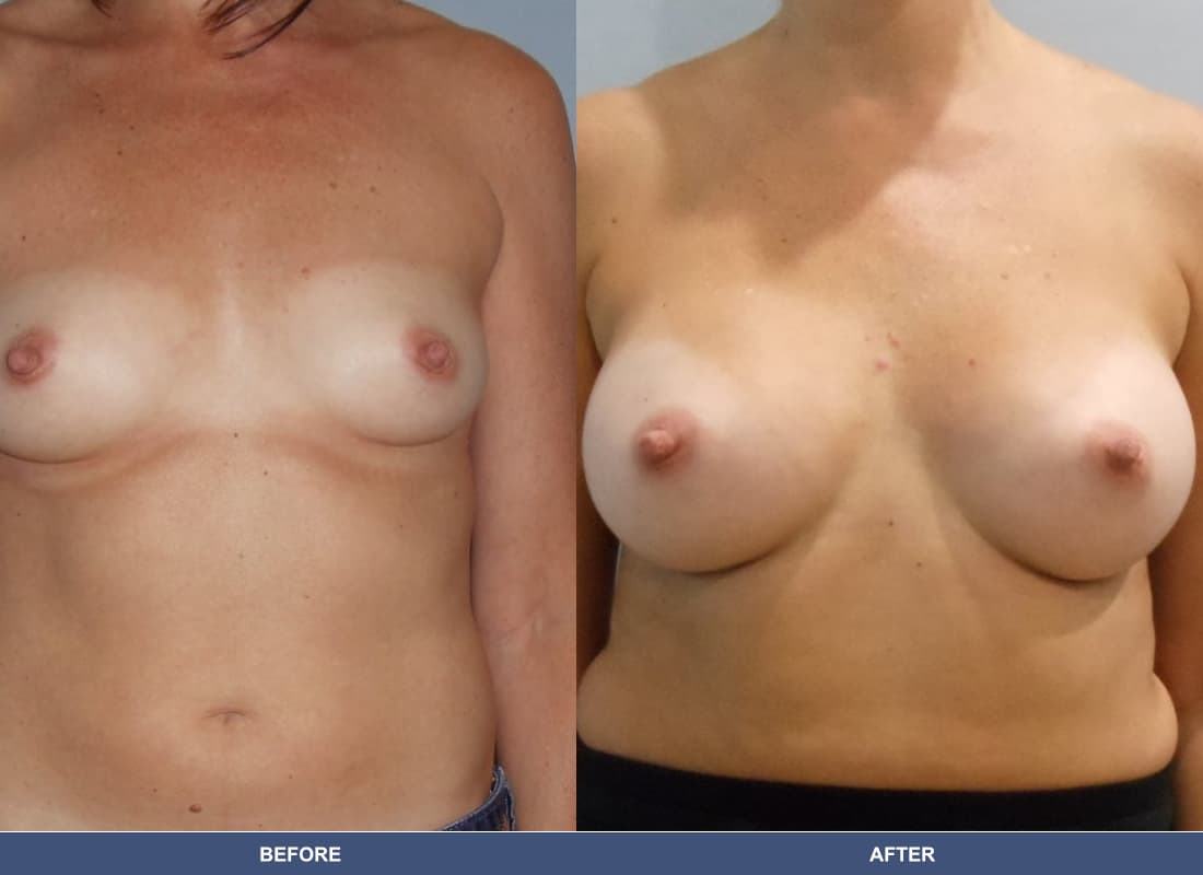 Painless Breast Implants before and after