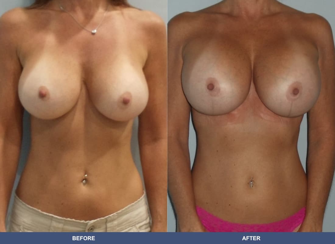 Painless Breast Implants before and after