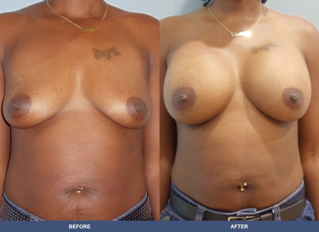 Painless Breast Implants before and after
