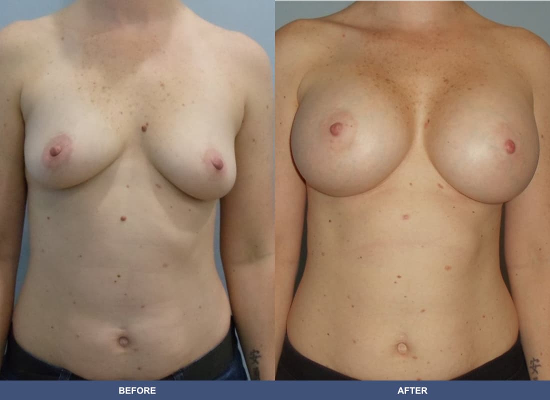 Painless Breast Implants before and after