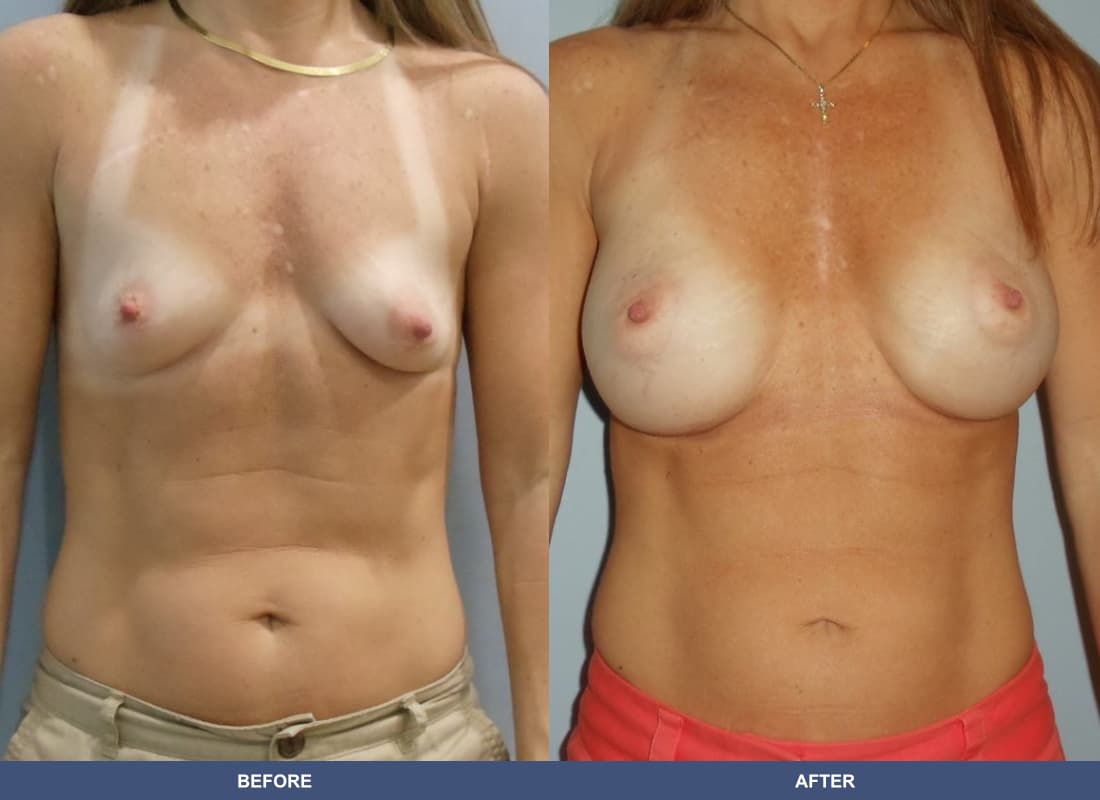 Painless Breast Implants before and after