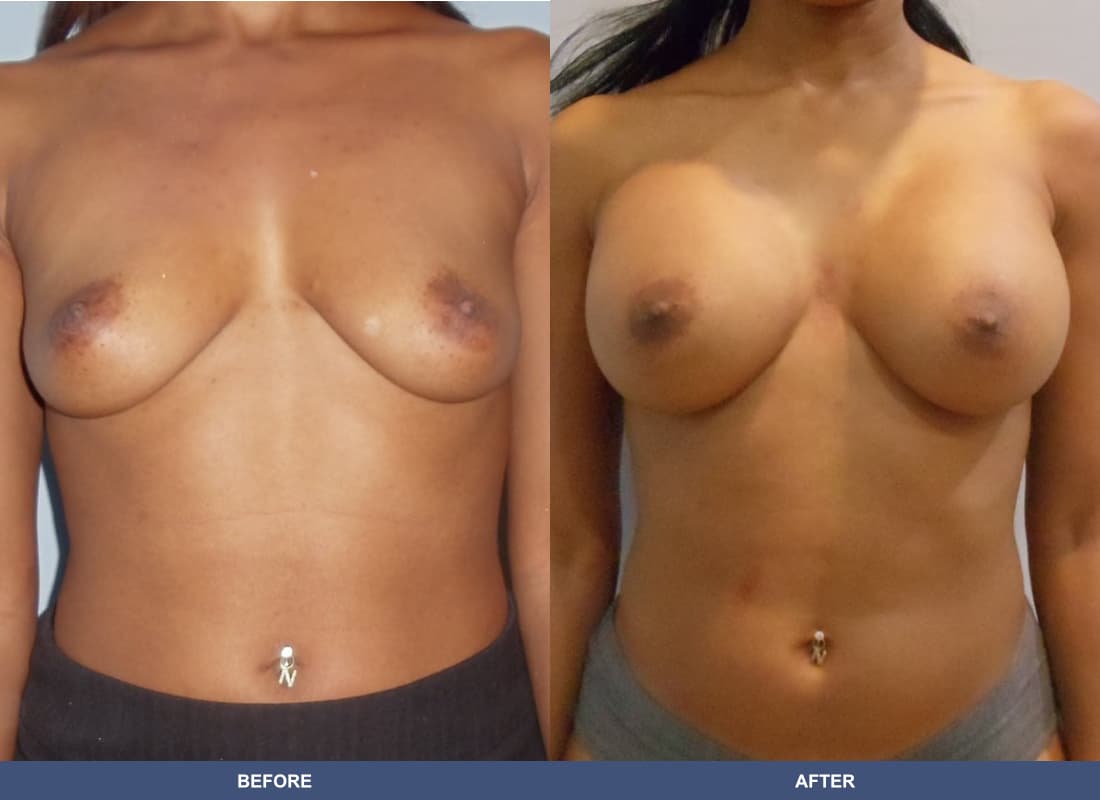 Painless Breast Implants before and after
