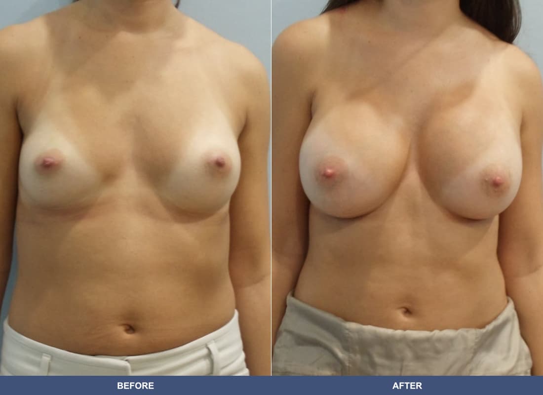 Painless Breast Implants before and after