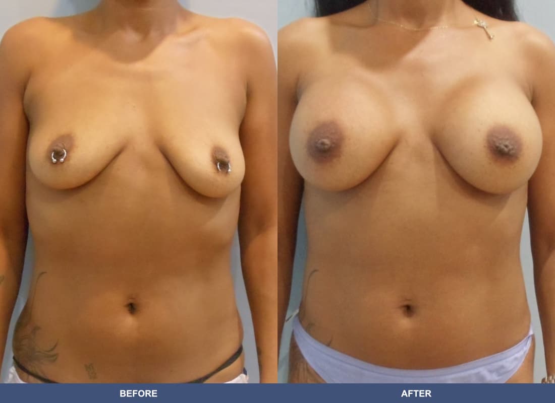 Painless Breast Implants before and after