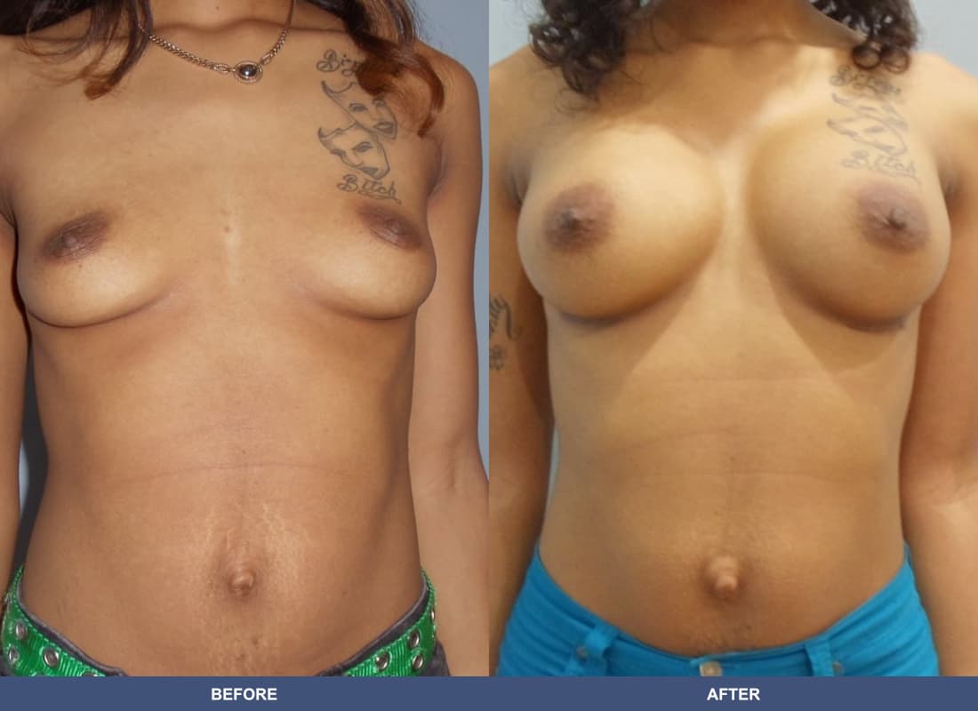 Painless Breast Implants before and after
