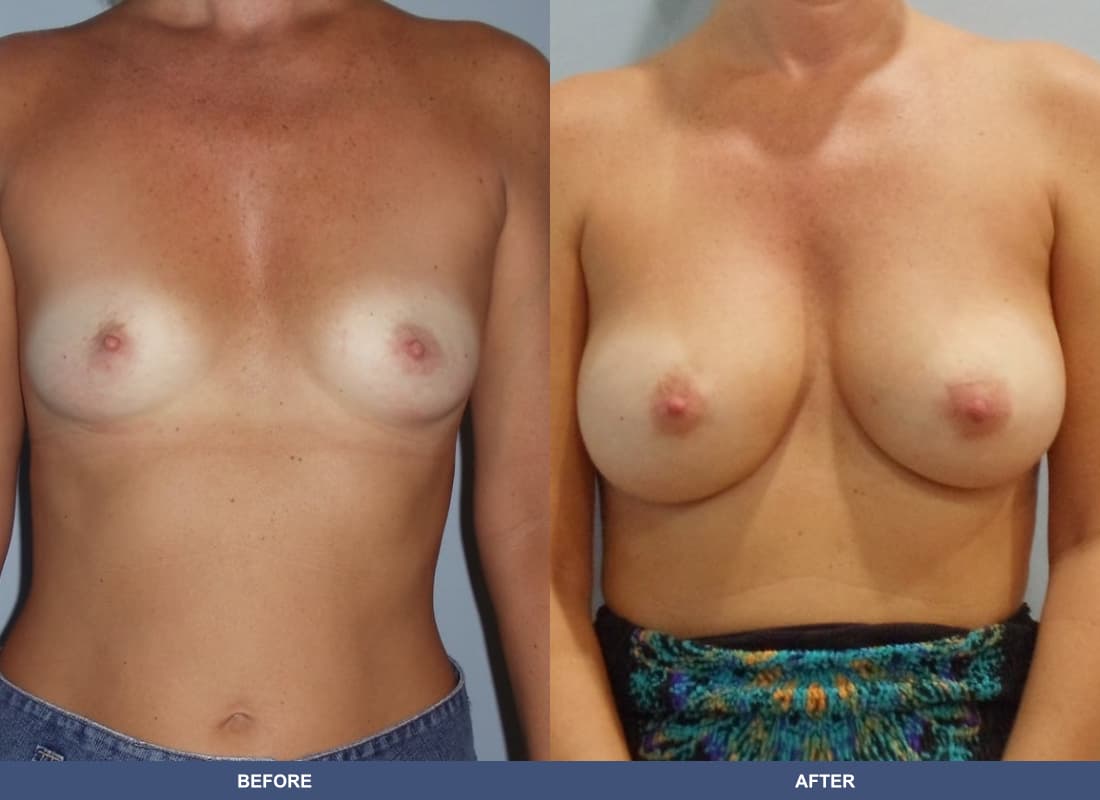 Painless Breast Implants before and after