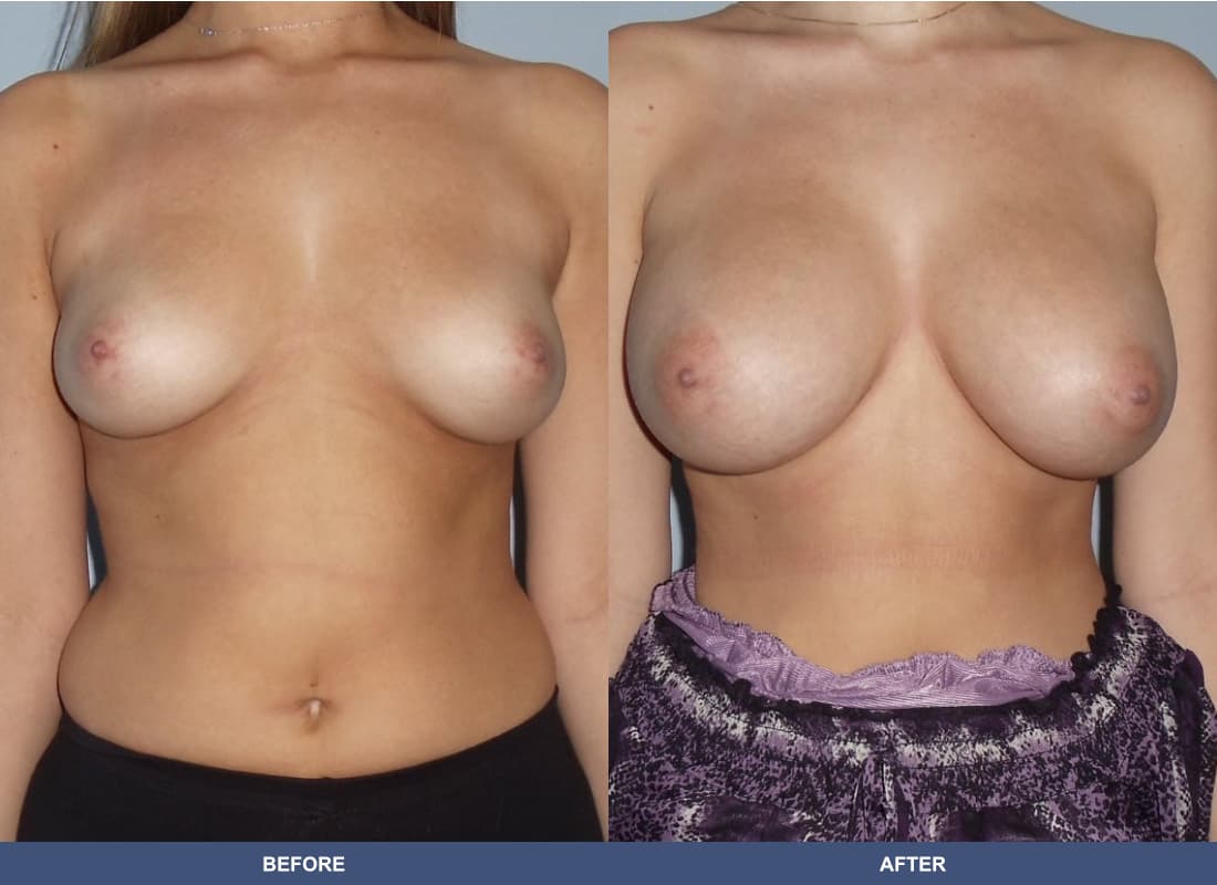 Painless Breast Implants before and after