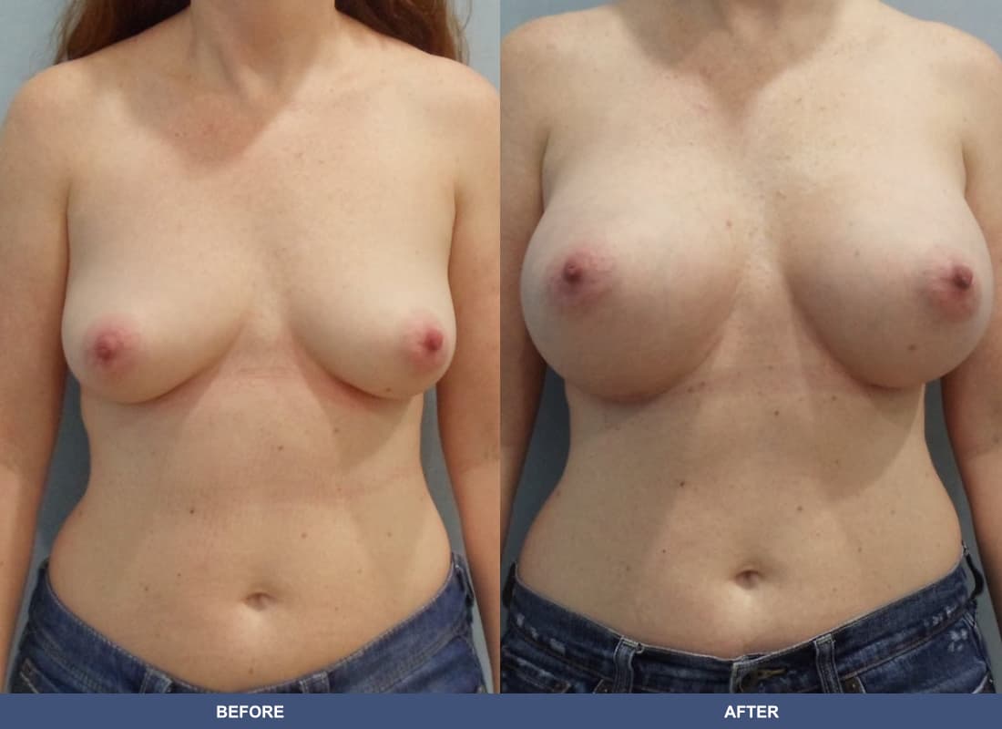 Painless Breast Implants before and after