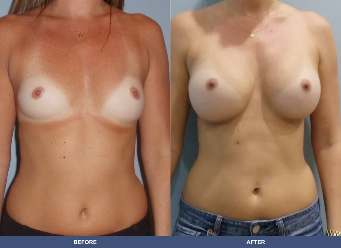 Painless Breast Implants before and after