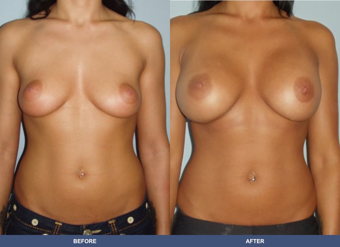 Painless Breast Implants before and after
