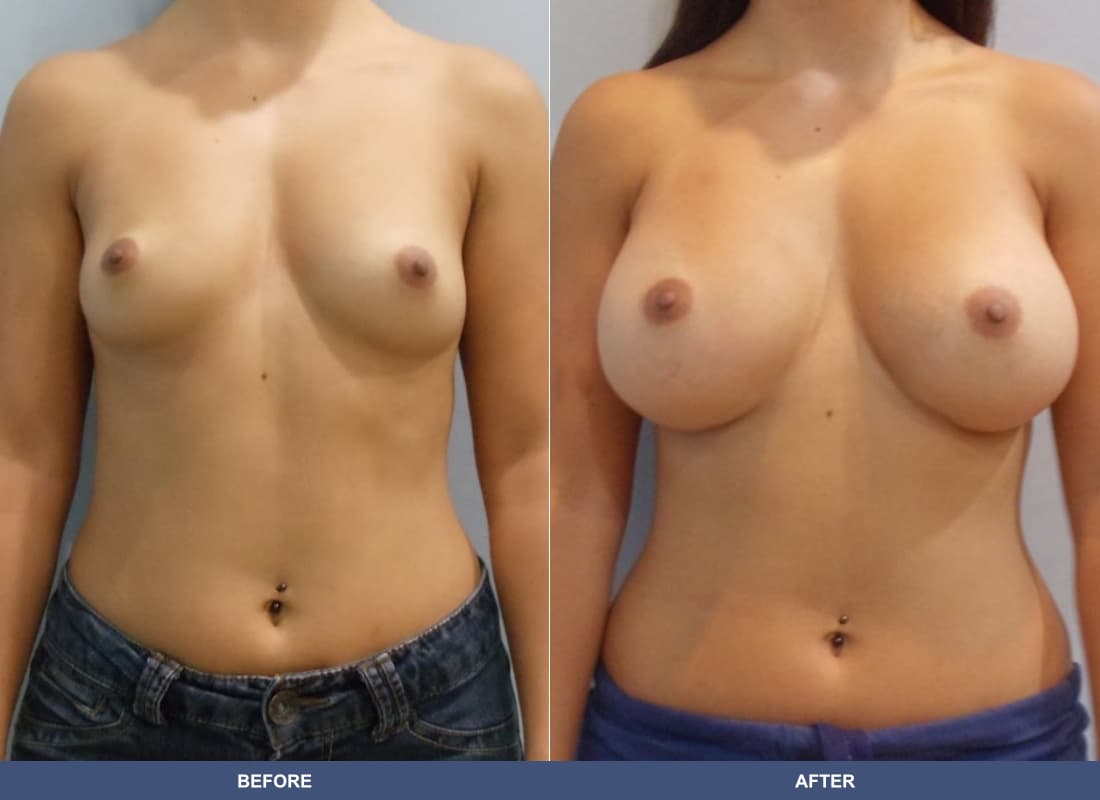 Painless Breast Implants before and after