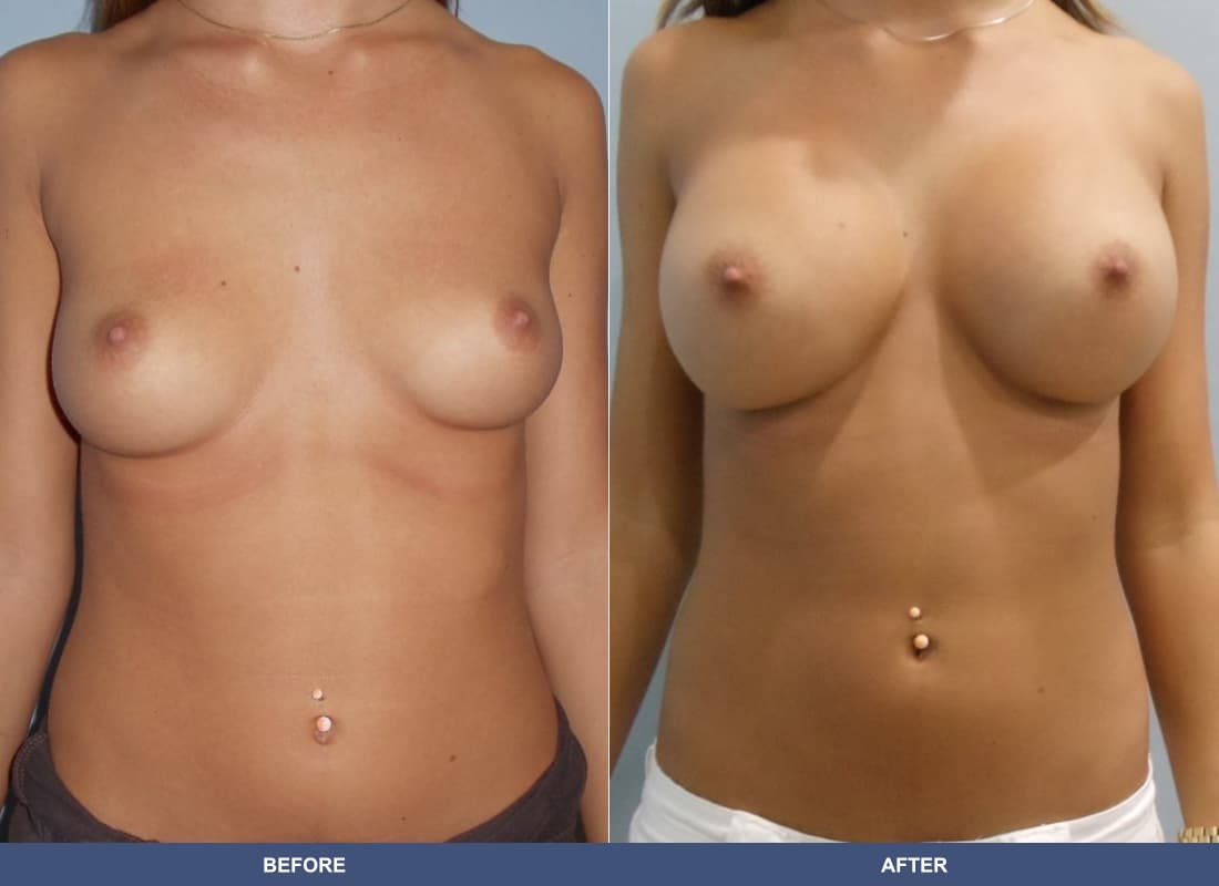 Painless Breast Implants before and after