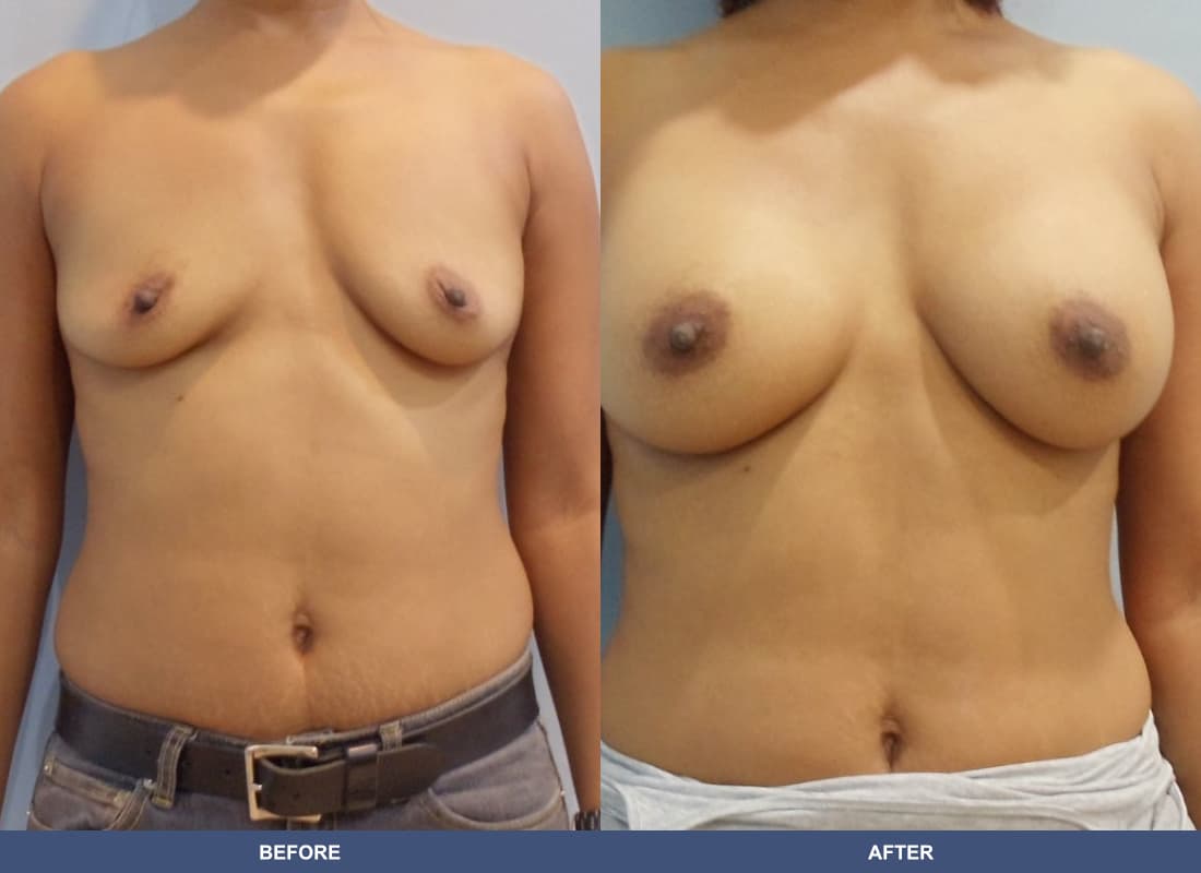 Painless Breast Implants before and after
