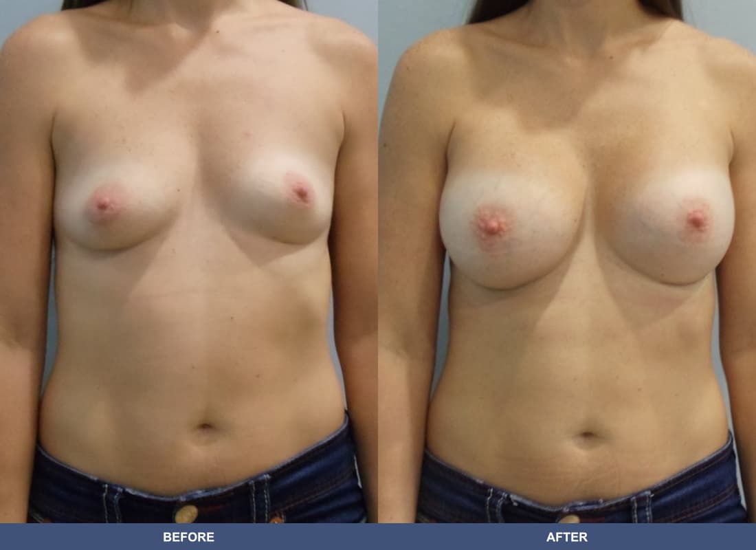 Painless Breast Implants before and after