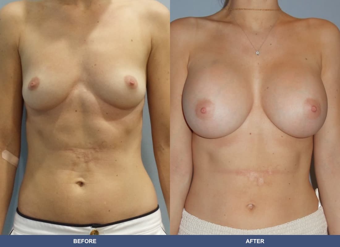Painless Breast Implants before and after