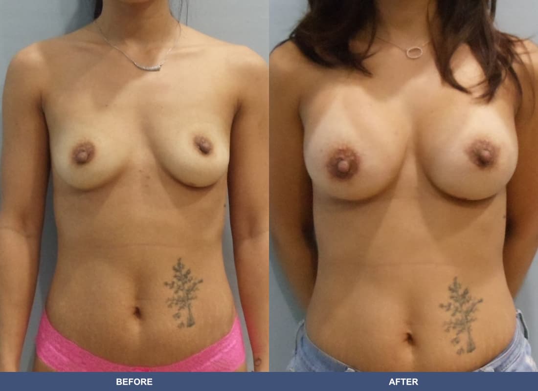 Painless Breast Implants before and after