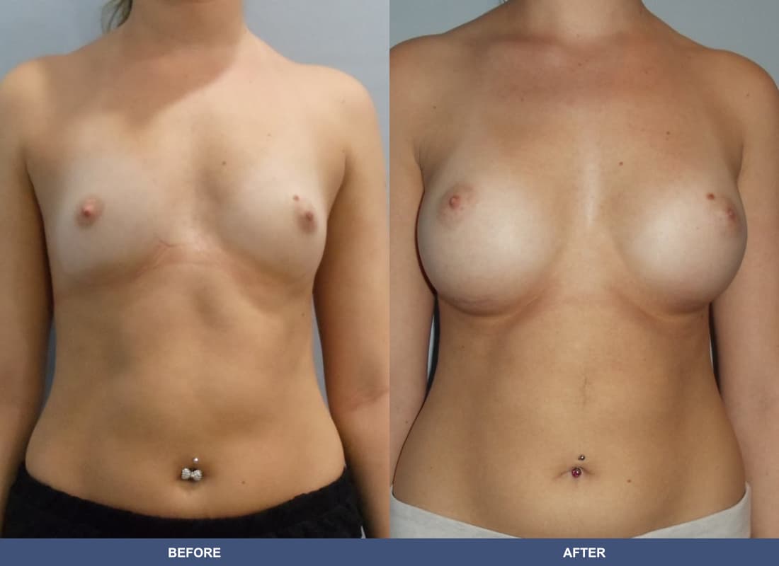 Painless Breast Implants before and after