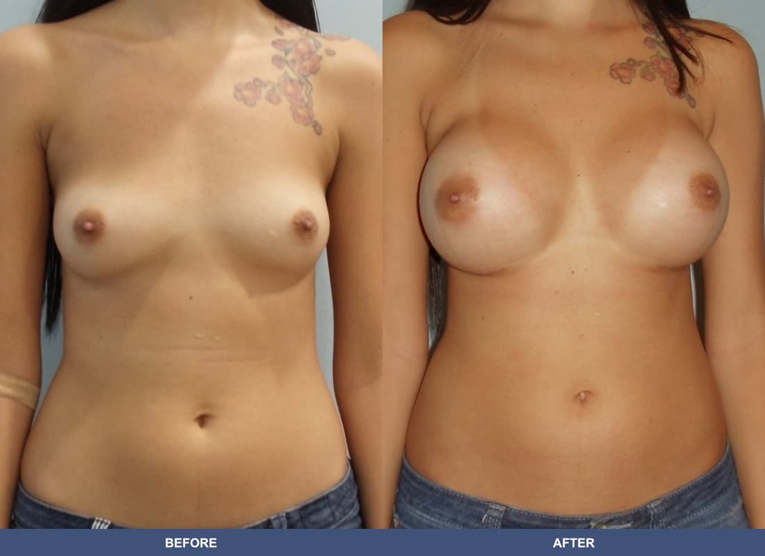 Painless Breast Implants before and after