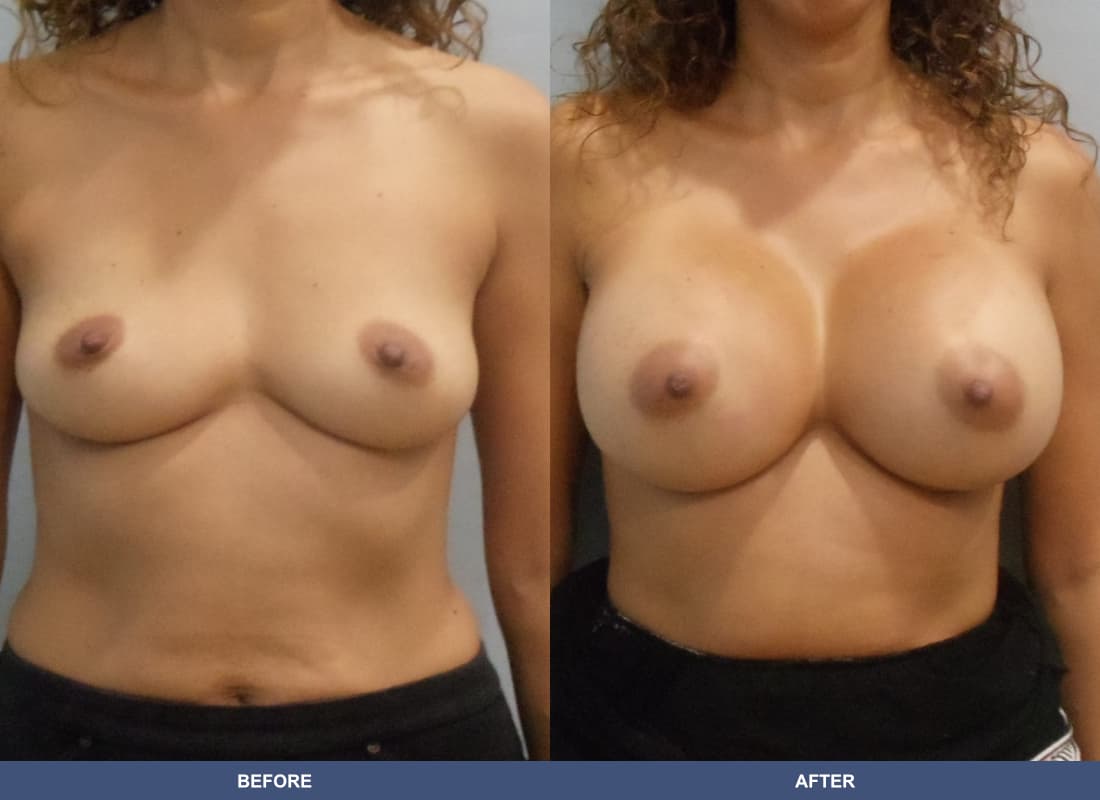Painless Breast Implants before and after