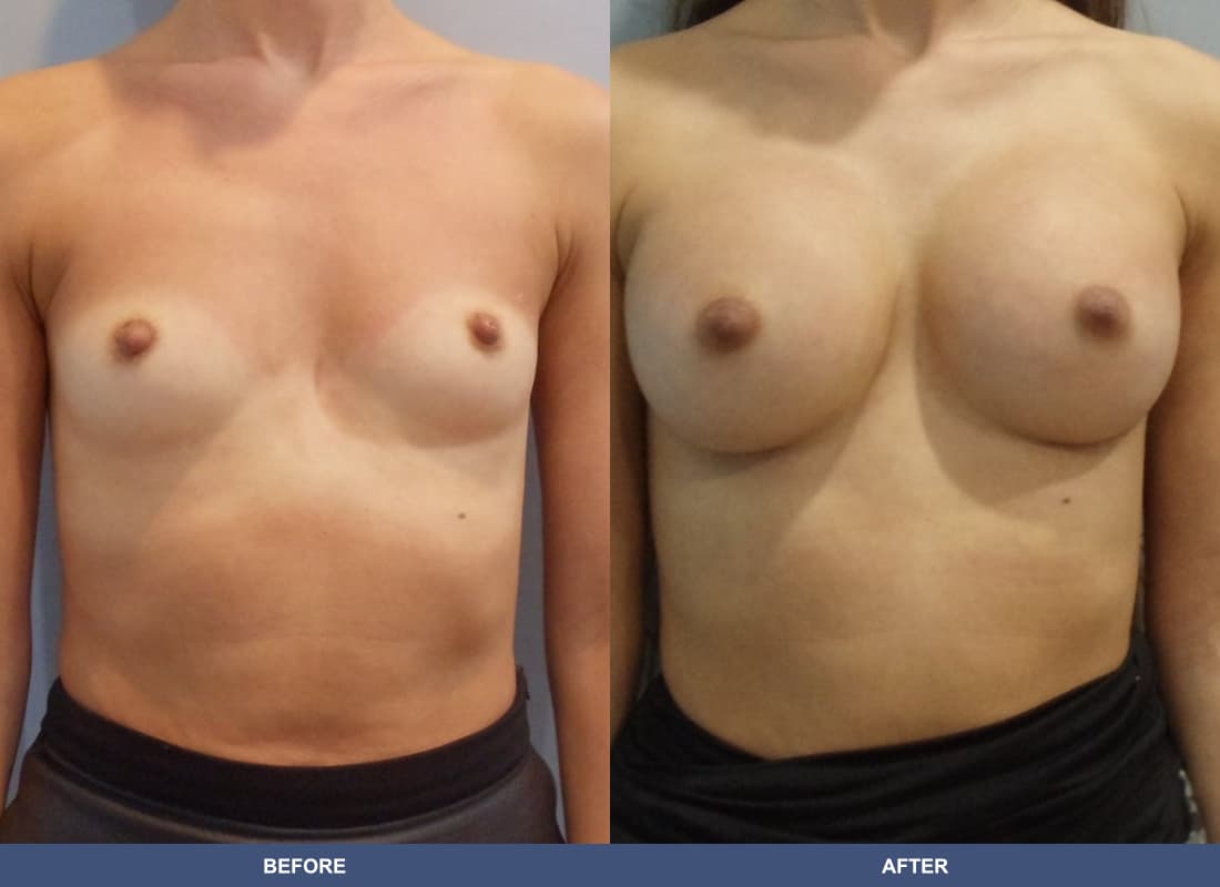 Painless Breast Implants before and after