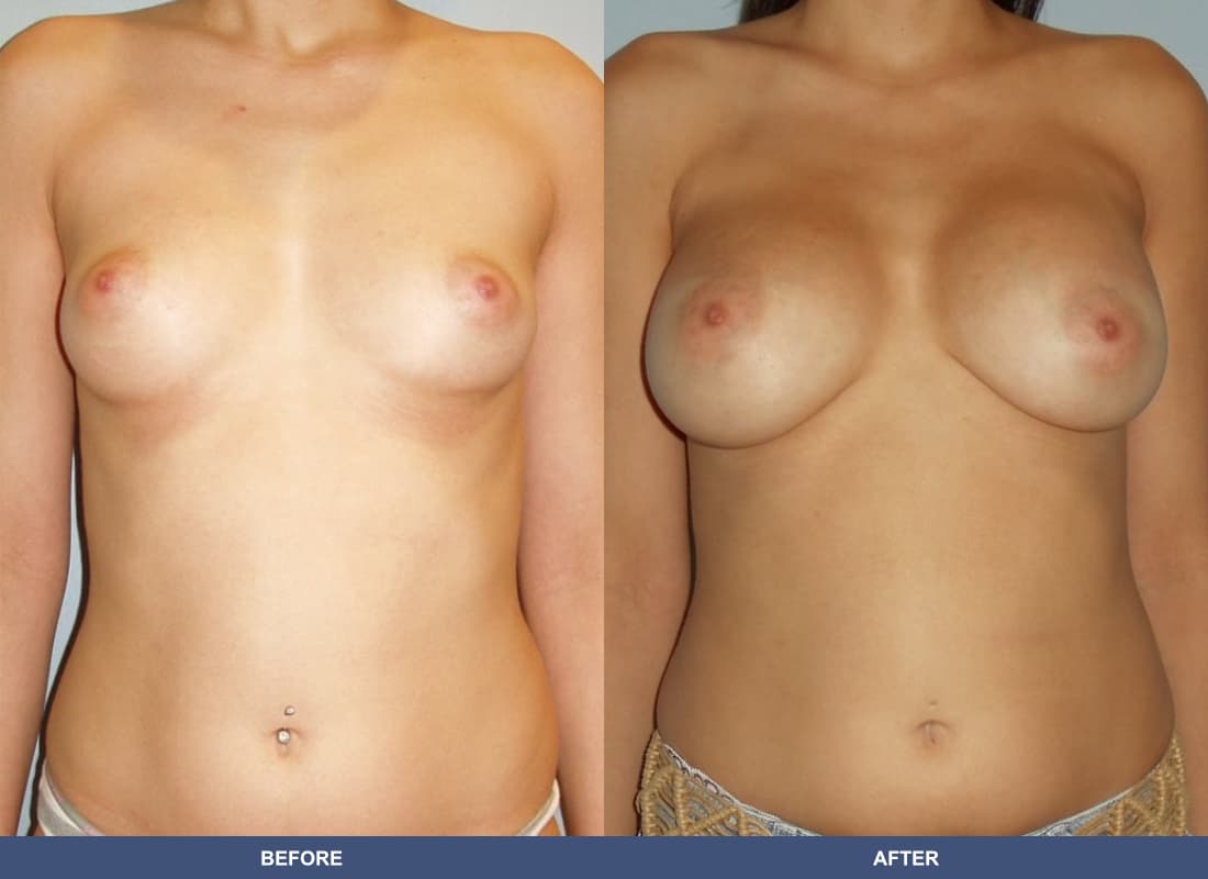 Painless Breast Implants before and after