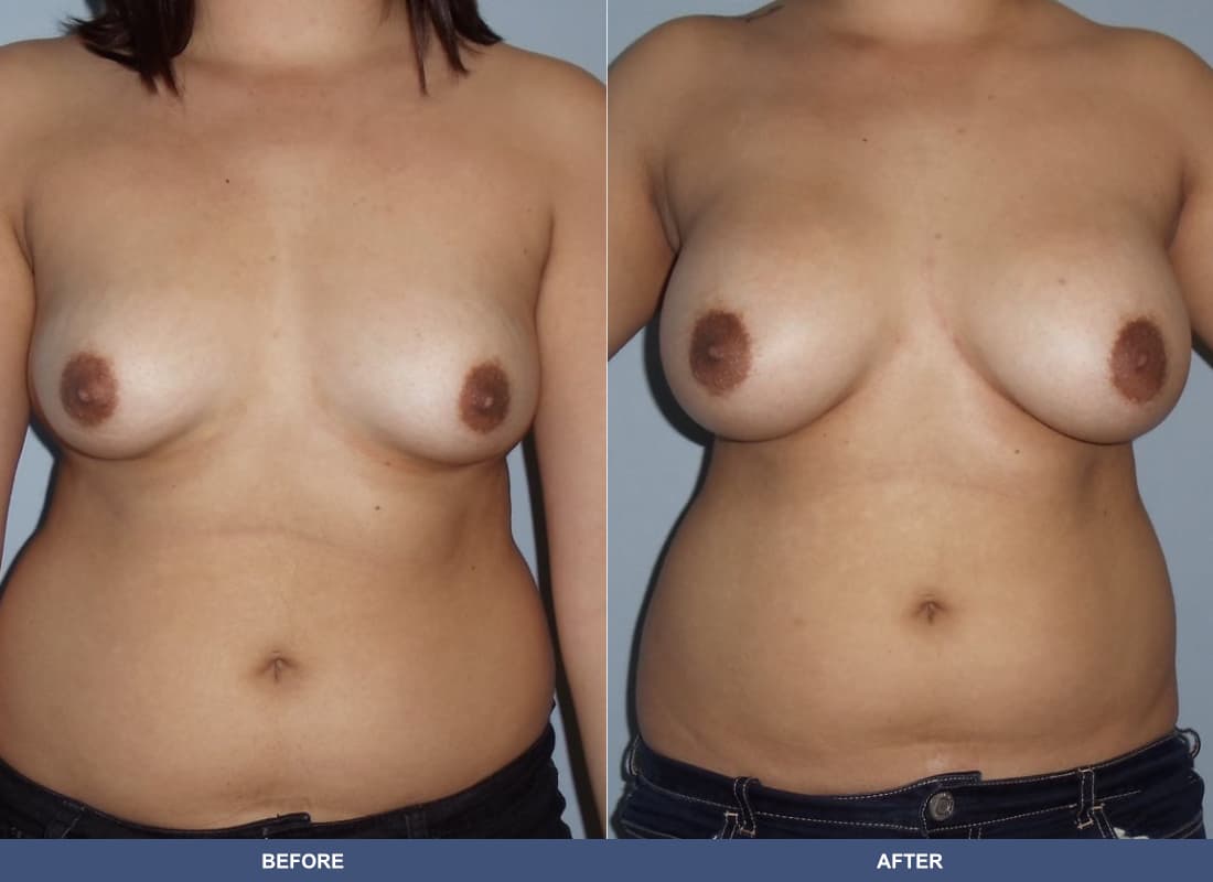 Painless Breast Implants before and after