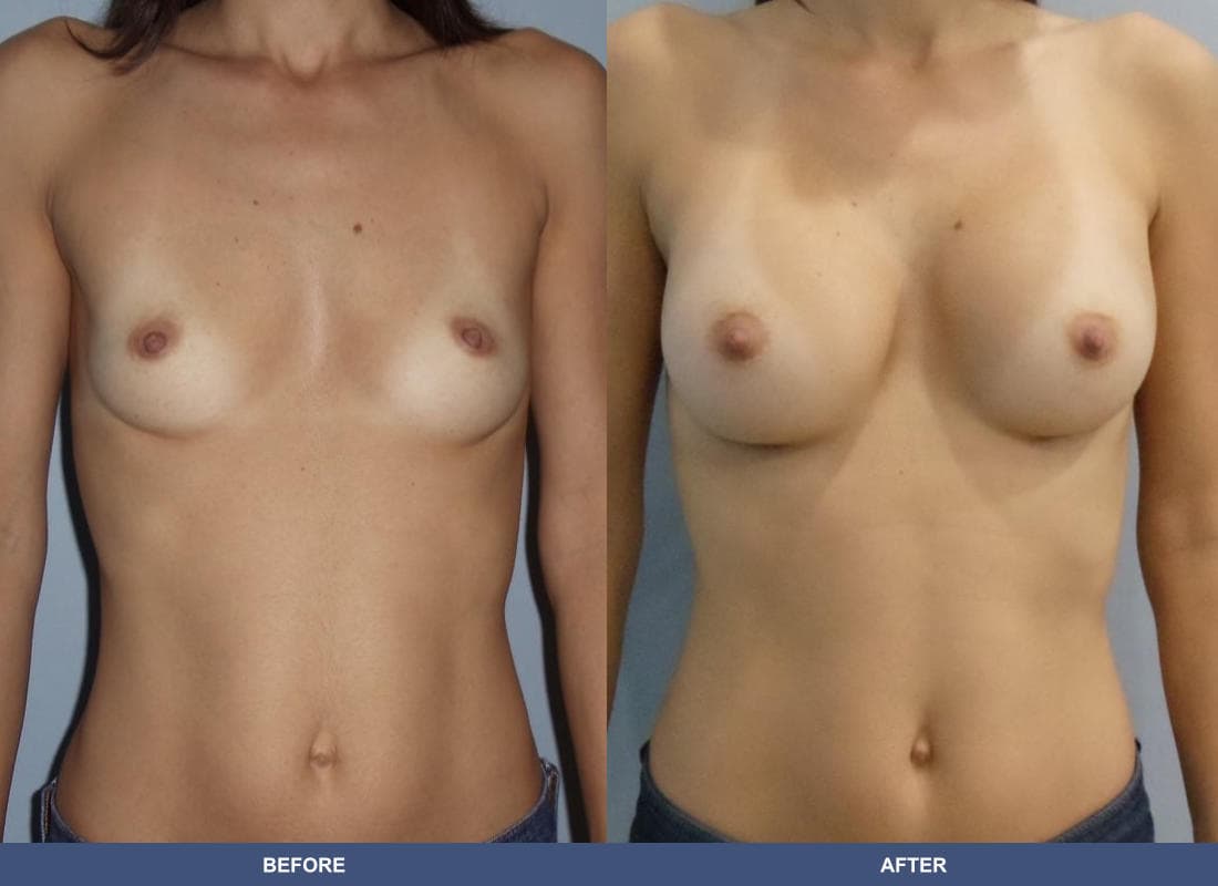 Painless Breast Implants before and after