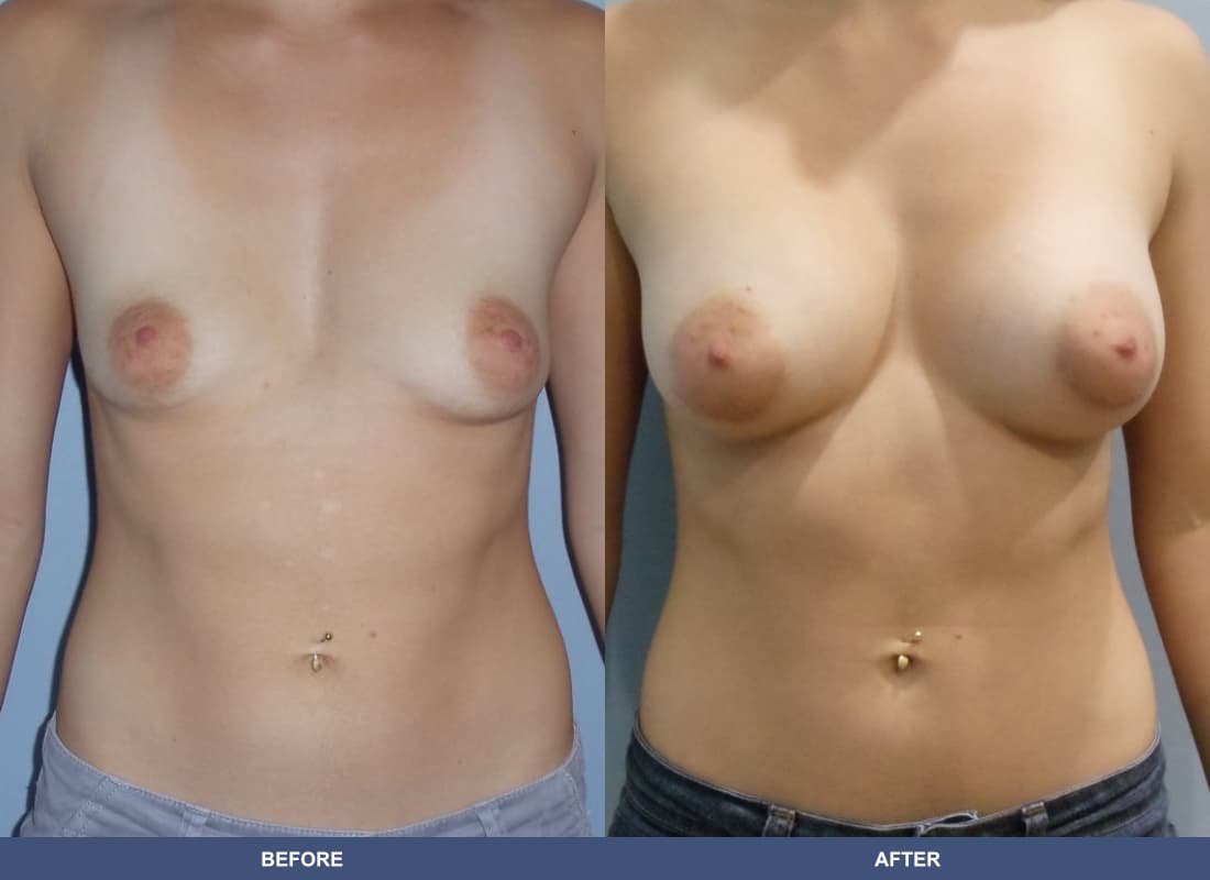 Painless Breast Implants before and after