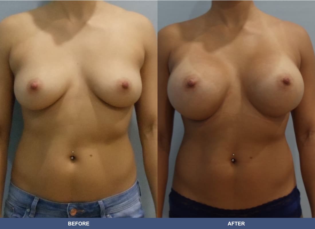 Painless Breast Implants before and after