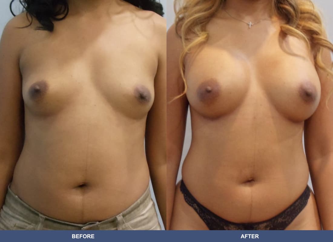 Painless Breast Implants before and after