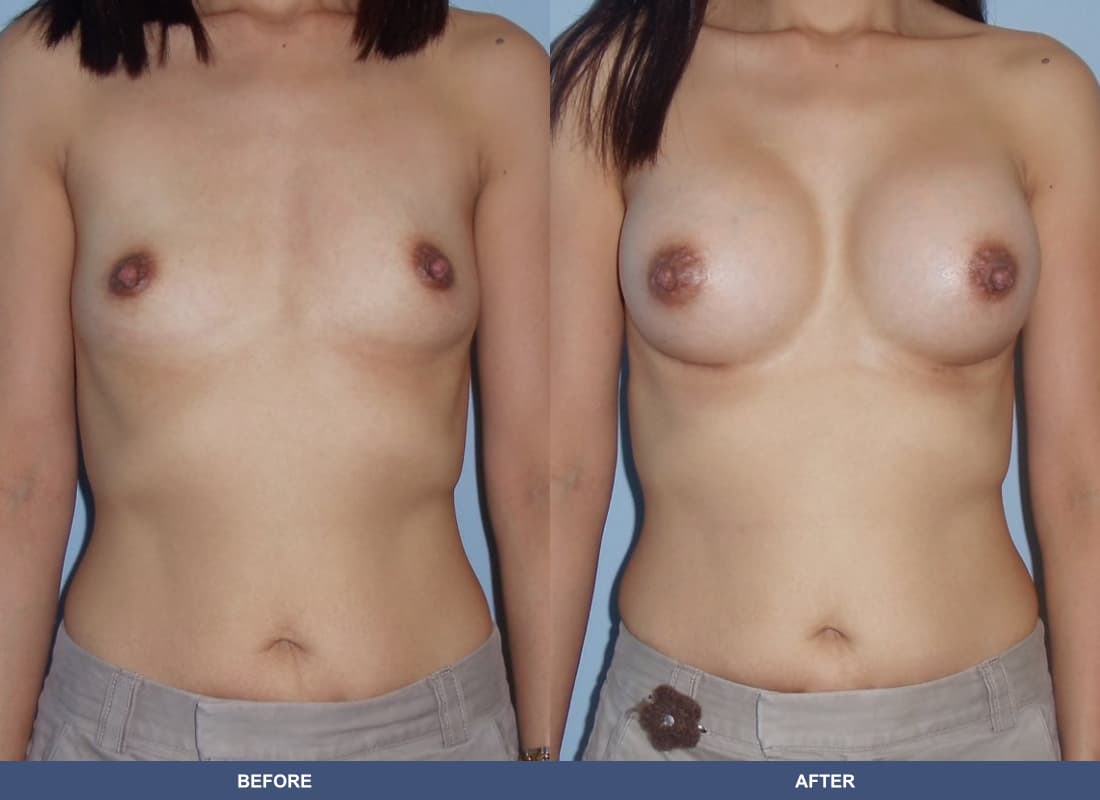 Painless Breast Implants before and after
