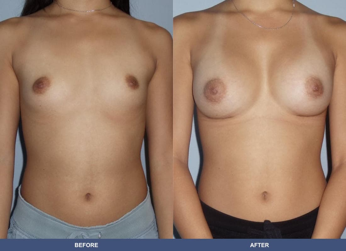 Painless Breast Implants before and after