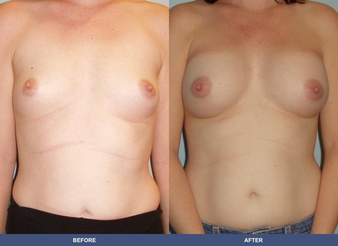 Painless Breast Implants before and after