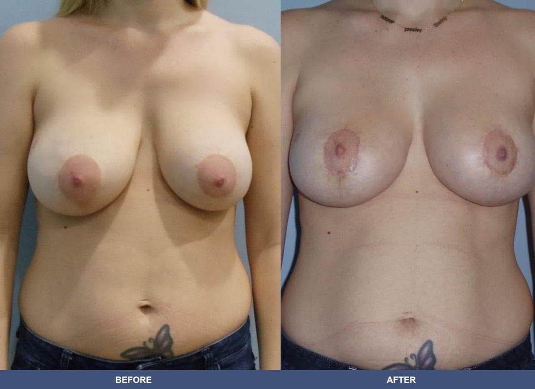 Breast Augmentation with a Lift before and after