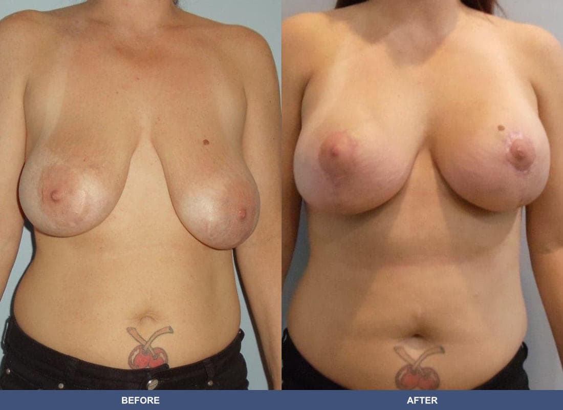 Breast Augmentation with a Lift before and after