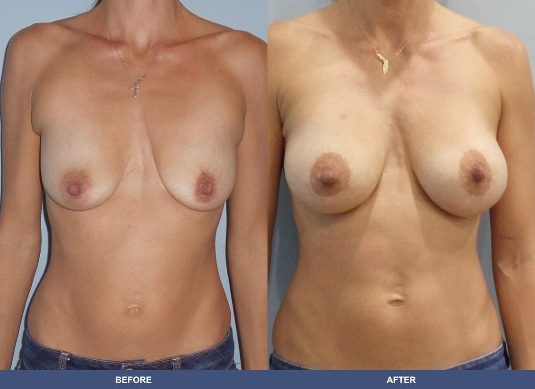 Breast Augmentation with a Lift before and after