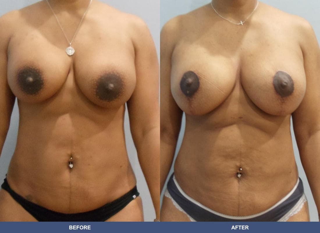 Breast Augmentation with a Lift before and after