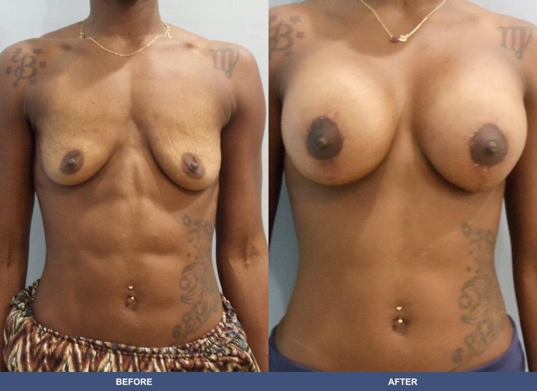 Breast Augmentation with a Lift before and after