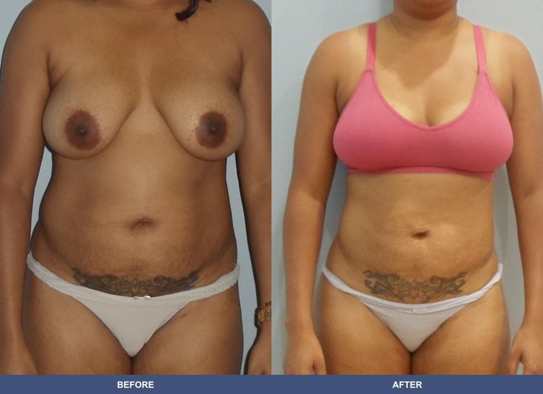 Brazilian Butt Lift before and after