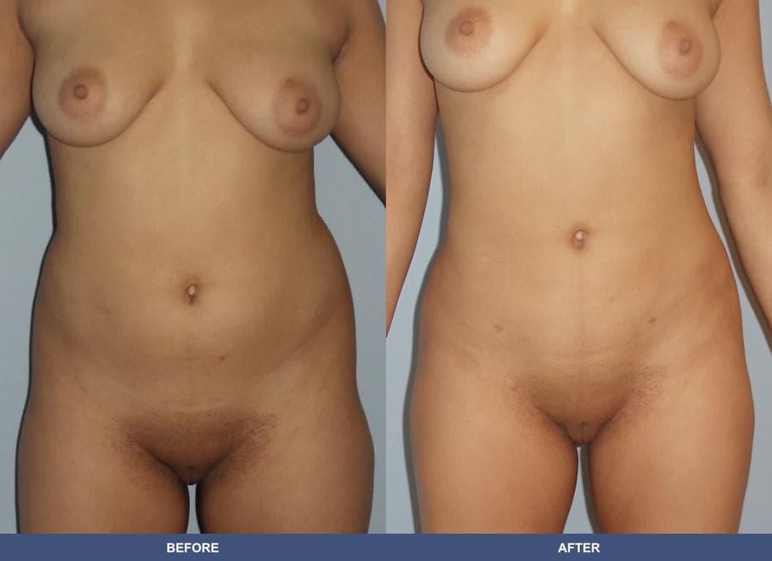 Brazilian Butt Lift before and after