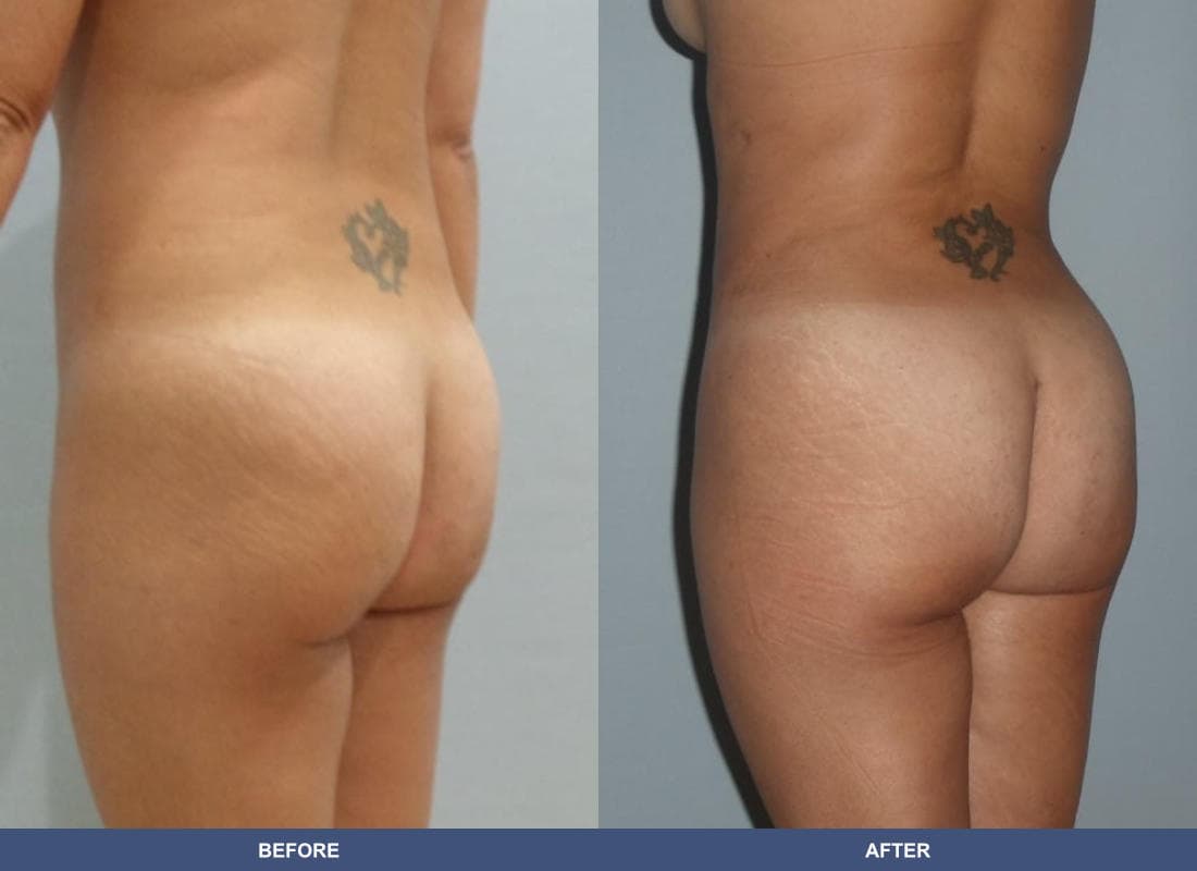 Brazilian Butt Lift before and after